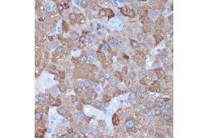 Immunohistochemistry of paraffin-embedded human liver cancer using L1 Rabbit mAb (ABIN7265535) at dilution of 1:100 (40x lens). (ALDH1L1 anticorps)