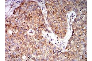 Immunohistochemical analysis of paraffin-embedded bladder cancer tissues using EIF5 mouse mAb with DAB staining.