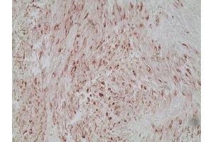 Immunohistochemistry analysis of human melanoma skin tissue using Melanoma marker (human) mAb (HMB45), (ABIN7211713) at a dilution of 1:20. (Melanoma Marker anticorps)