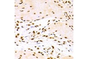 Immunohistochemistry of paraffin-embedded human gastric cancer using DDB1 Antibody. (DDB1 anticorps)