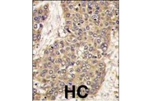 Formalin-fixed and paraffin-embedded human hepatocarcinoma tissue reacted with CASP6 antibody (C-term), which was peroxidase-conjugated to the secondary antibody, followed by DAB staining. (Caspase 6 anticorps  (C-Term))