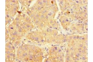 Immunohistochemistry of paraffin-embedded human liver cancer using ABIN7175166 at dilution of 1:100 (UGP2 anticorps  (AA 1-497))