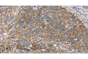 Immunohistochemistry of paraffin-embedded Human cervical cancer tissue using CENPO Polyclonal Antibody at dilution 1:40 (CENPO anticorps)