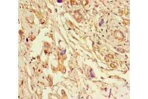 Immunohistochemistry of paraffin-embedded human pancreatic cancer using ABIN7151998 at dilution of 1:100 (ERLIN2 anticorps  (AA 25-206))