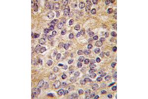 Formalin-fixed and paraffin-embedded human prostata carcinoma tissue reacted with PLAU antibody (C-term ), which was peroxidase-conjugated to the secondary antibody, followed by DAB staining. (PLAU anticorps  (C-Term))