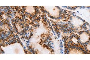 Immunohistochemistry of paraffin-embedded Human thyroid cancer tissue using MUC6 Polyclonal Antibody at dilution 1:40 (MUC6 anticorps)
