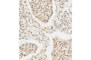 C staining HS in human lung adenocarcinoma tissue sections by Immunohistochemistry (IHC-P - paraformaldehyde-fixed, paraffin-embedded sections). (HSPA7 anticorps  (AA 169-196))