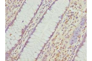 Immunohistochemistry of paraffin-embedded human colon cancer using ABIN7156409 at dilution of 1:100 (Integrator Complex Subunit 14 (INTS14) (AA 231-518) anticorps)