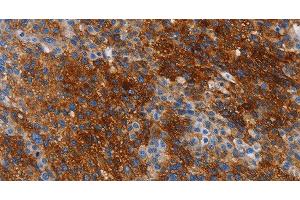 Immunohistochemistry of paraffin-embedded Human liver cancer tissue using CA9 Polyclonal Antibody at dilution 1:50 (CA9 anticorps)