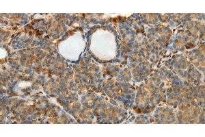 Immunohistochemistry of paraffin-embedded Human thyroid cancer using SULT1E1 Polyclonal Antibody at dilution of 1:30 (SULT1E1 anticorps)