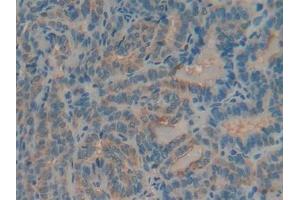 Detection of MUC5AC in Human Thyroid cancer Tissue using Polyclonal Antibody to Mucin 5 Subtype AC (MUC5AC)