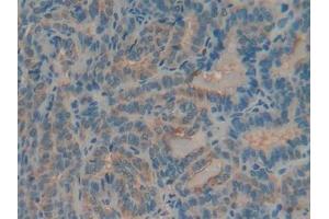 Detection of MUC5AC in Human Thyroid cancer Tissue using Polyclonal Antibody to Mucin 5 Subtype AC (MUC5AC) (MUC5AC anticorps)