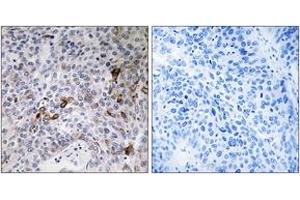 Immunohistochemistry analysis of paraffin-embedded human lung carcinoma tissue, using RAB11FIP3 Antibody.