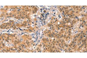 Immunohistochemistry of paraffin-embedded Human gastric cancer using EIF4G1 Polyclonal Antibody at dilution of 1:30