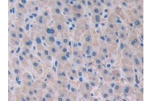 Detection of ATXN10 in Human Liver cancer Tissue using Polyclonal Antibody to Ataxin 10 (ATXN10)