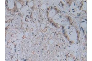 DAB staining on IHC-P;;Samples: Human Pancreatic cancer Tissue (CCL2 anticorps  (AA 24-99))