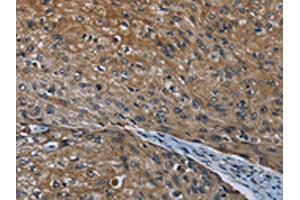 The image on the left is immunohistochemistry of paraffin-embedded Human esophagus cancer tissue using ABIN7190993(HOXC8 Antibody) at dilution 1/20, on the right is treated with synthetic peptide. (HOXC8 anticorps)