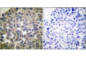 Immunohistochemistry analysis of paraffin-embedded human breast carcinoma tissue, using PLCG1 (Ab-771) Antibody. (Phospholipase C gamma 1 anticorps  (AA 736-785))