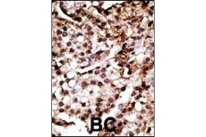 Formalin-fixed and paraffin-embedded human cancer tissue reacted with the primary antibody, which was peroxidase-conjugated to the secondary antibody, followed by AEC staining.