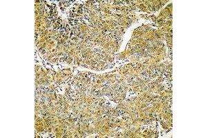 Immunohistochemical analysis of SVOP staining in human liver cancer formalin fixed paraffin embedded tissue section. (SVOP anticorps)
