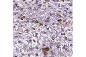 BNIPL Antibody on lung cancer by IHC.