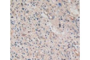 Detection of AREG in Human Glioma Tissue using Monoclonal Antibody to Amphiregulin (AREG)