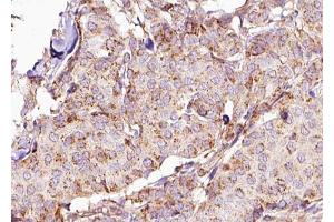 ABIN6267668 at 1/100 staining Human breast cancer tissue by IHC-P. (DPYSL2 anticorps  (pThr514))