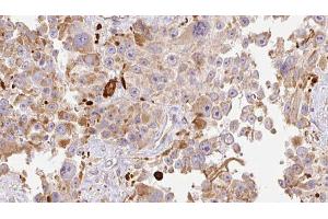 ABIN6274013 at 1/100 staining Human Melanoma tissue by IHC-P. (HAPLN1 anticorps  (N-Term))