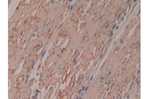 Detection of RI in Human Colorectal cancer Tissue using Polyclonal Antibody to Ribonuclease Inhibitor (RI)