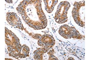 The image on the left is immunohistochemistry of paraffin-embedded Human colon cancer tissue using ABIN7190920(HCRTR1 Antibody) at dilution 1/70, on the right is treated with synthetic peptide. (HCRTR1 anticorps)