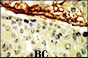 Formalin-fixed and paraffin-embedded human cancer tissue reacted with the primary antibody, which was peroxidase-conjugated to the secondary antibody, followed by DAB staining.