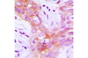 Immunohistochemical analysis of IGF1 Receptor (pY1161) staining in human breast cancer formalin fixed paraffin embedded tissue section.