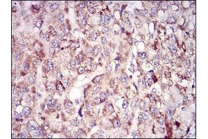 Immunohistochemical analysis of paraffin-embedded liver cancer tissues using TUBE1 mouse mAb with DAB staining.