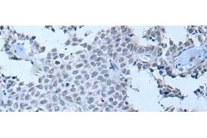 Immunohistochemistry of paraffin-embedded Human ovarian cancer tissue using ZNF703 Polyclonal Antibody at dilution of 1:55(x200)