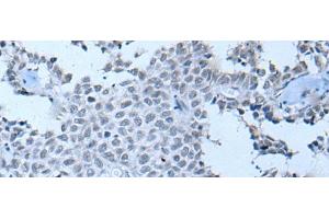Immunohistochemistry of paraffin-embedded Human ovarian cancer tissue using ZNF703 Polyclonal Antibody at dilution of 1:55(x200) (ZNF703 anticorps)