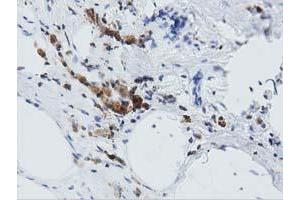 Immunohistochemical staining of paraffin-embedded Carcinoma of Human lung tissue using anti-ARHGAP25 mouse monoclonal antibody. (ARHGAP25 anticorps)