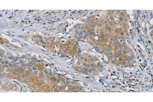 Immunohistochemistry of paraffin-embedded Human ovarian cancer tissue using RASA2 Polyclonal Antibody at dilution 1:45