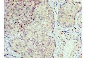 Immunohistochemistry of paraffin-embedded human cervical cancer using ABIN7168869 at dilution of 1:100