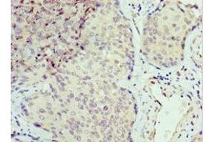 Immunohistochemistry of paraffin-embedded human cervical cancer using ABIN7168869 at dilution of 1:100 (Septin 6 anticorps  (AA 350-434))