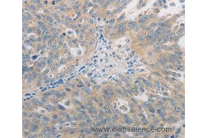 Immunohistochemistry of Human ovarian cancer using GJB6 Polyclonal Antibody at dilution of 1:60 (GJB6 anticorps)