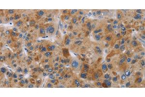 Immunohistochemistry of paraffin-embedded Human liver cancer tissue using IAPP Polyclonal Antibody at dilution 1:40 (Amylin/DAP anticorps)