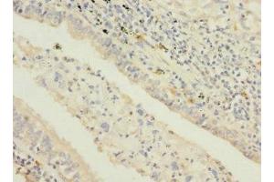 Immunohistochemistry of paraffin-embedded human lung cancer using ABIN7169694 at dilution of 1:100 (STAM2 anticorps  (AA 376-525))