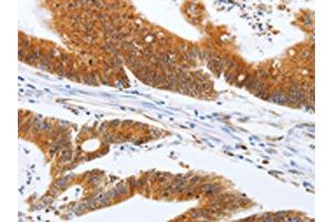 The image on the left is immunohistochemistry of paraffin-embedded Human colon cancer tissue using ABIN7131154(SPATA13 Antibody) at dilution 1/20, on the right is treated with fusion protein. (SPATA13 anticorps)