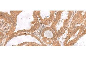 Immunohistochemistry of paraffin-embedded Human thyroid cancer tissue using ETV3 Polyclonal Antibody at dilution of 1:25(x200) (ETV3 anticorps)