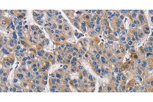 Immunohistochemistry of paraffin-embedded Human liver cancer tissue using KLK1 Polyclonal Antibody at dilution 1:40 (Kallikrein 1 anticorps)