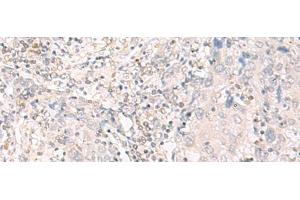 Immunohistochemistry of paraffin-embedded Human cervical cancer tissue using IL12B Polyclonal Antibody at dilution of 1:35(x200) (IL12B anticorps)