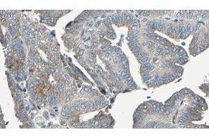 ABIN6277082 at 1/100 staining Human cervical cancer tissue by IHC-P. (TRKA anticorps  (C-Term))