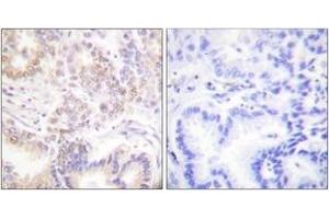 Immunohistochemistry analysis of paraffin-embedded human lung carcinoma tissue, using SENP5 Antibody. (SENP5 anticorps  (AA 651-700))