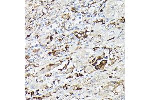 Immunohistochemistry of paraffin-embedded human liver cancer using Gelsolin Rabbit pAb (ABIN7267365) at dilution of 1:50 (40x lens).