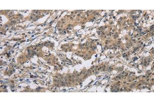 Immunohistochemistry of paraffin-embedded Human gastric cancer tissue using DSG2 Polyclonal Antibody at dilution 1:50 (Desmoglein 2 anticorps)